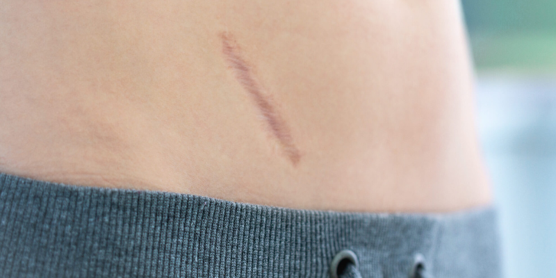 Pourquoi consulter un.e ostéopathe après une chirurgie abdominale ou pelvienne?